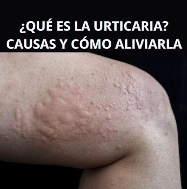 Tipos de erupciones en la piel