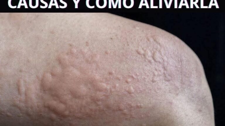 Tipos de erupciones en la piel