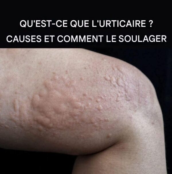 Tipos de Erupciones Cutáneas