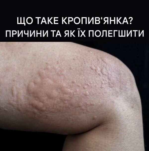 Види шкірних висипань