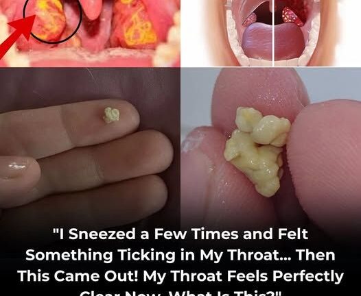 “Tonsil Stones Explained: What They Are and How to Deal With Them”