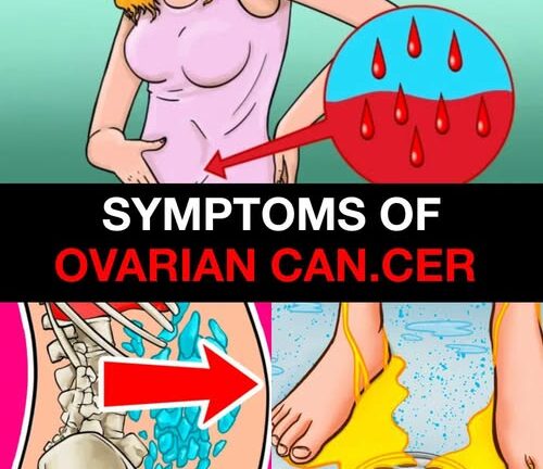 The Link Between Ovarian and Bre.ast Can.cer: What Every Woman Should Know