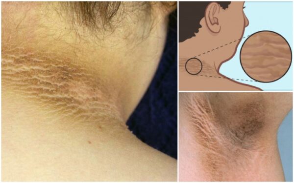 Home Remedy to Lighten Underarms