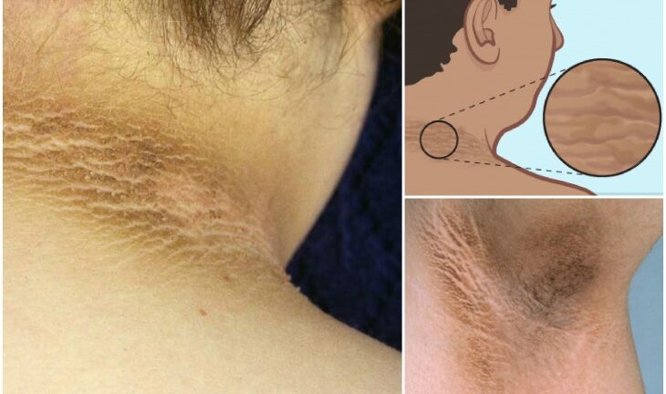 Home Remedy to Lighten Underarms