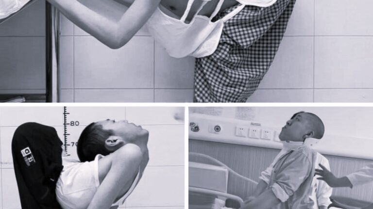 China ‘folded boy’ stands up straight for first time after surgeries to break, reset bones