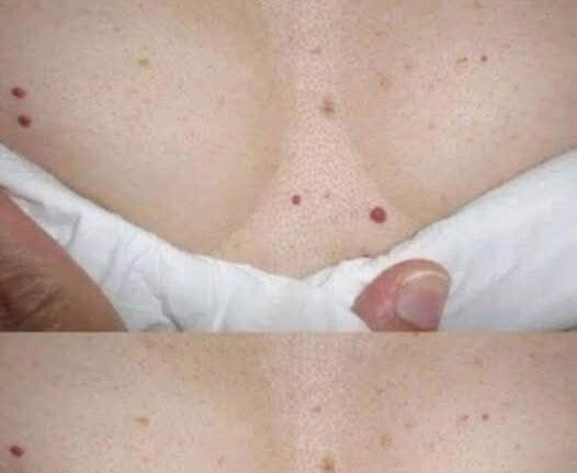 What are the red spots that appear on the skin?