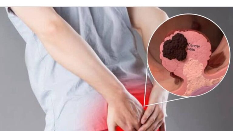 Colon Cancer: Why Is It Affecting More and More Young People?