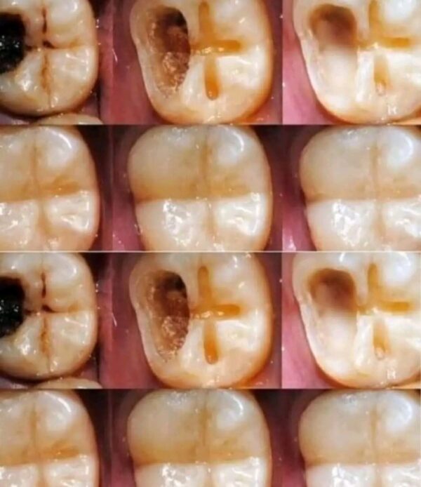 How To Naturally Repair A Cavity?