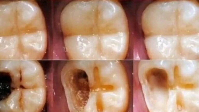 How To Naturally Repair A Cavity?