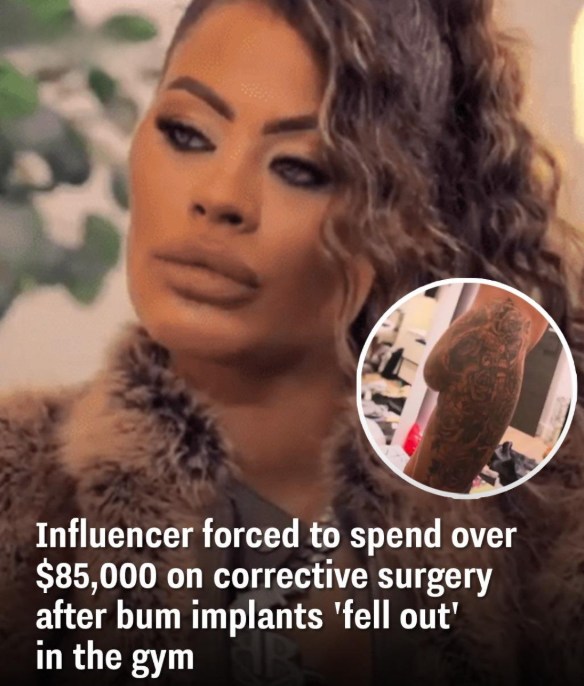 Influencer forced to spend over $85,000 on corrective surgery after bum implants ‘fell out’ in the gym
