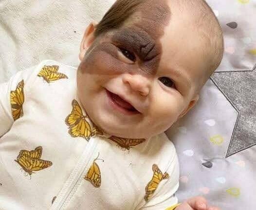 Parents Love Drives Them to Remove Daughters Birthmark… See more