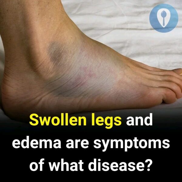 Swollen legs and edema are symptoms of what disease?
