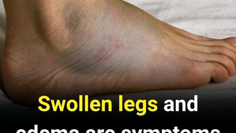 Swollen legs and edema are symptoms of what disease?