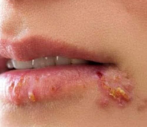 If you see this appearing on your lips, it is a sign of ca….