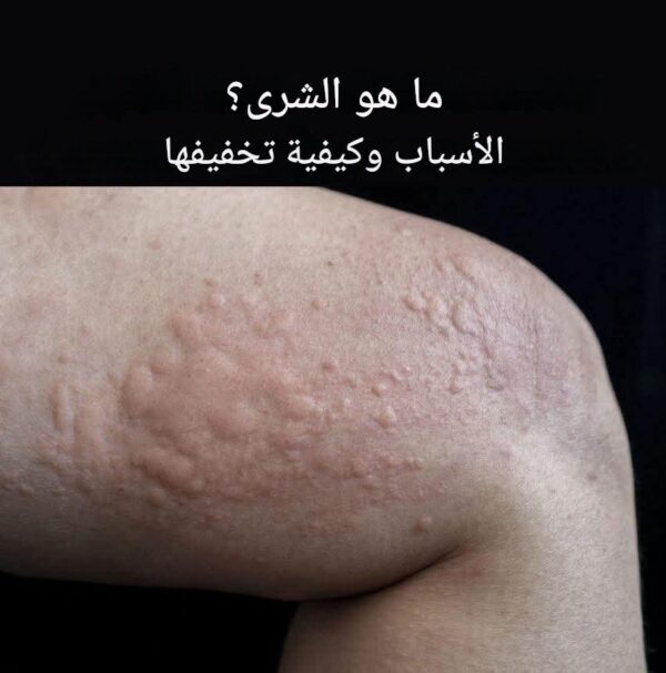 أنواع الطفح الجلدي