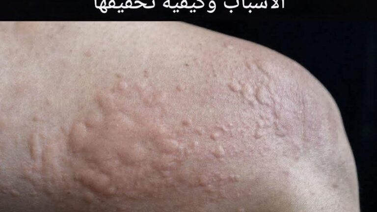 أنواع الطفح الجلدي