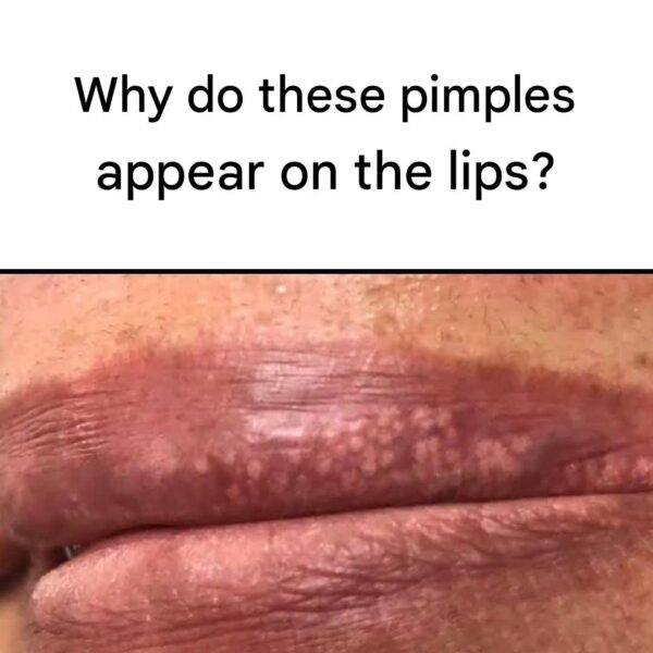 Why Do White Spots Appear on the Lips? 🔍