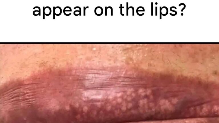 Why Do White Spots Appear on the Lips? 🔍